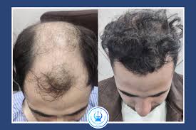 Hair Transplant01